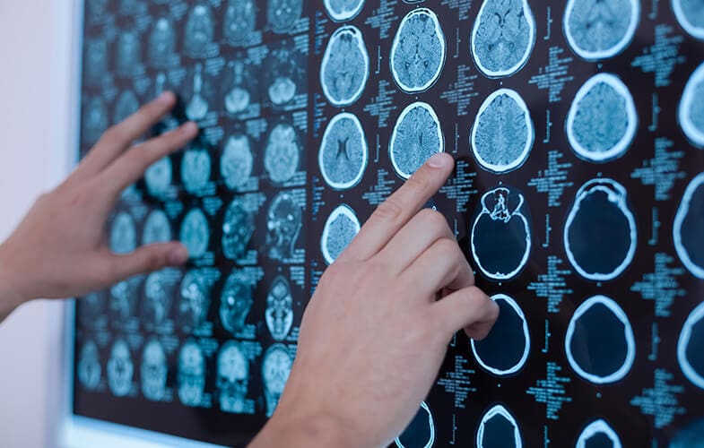 Early Onset Dementia: What you need to know
